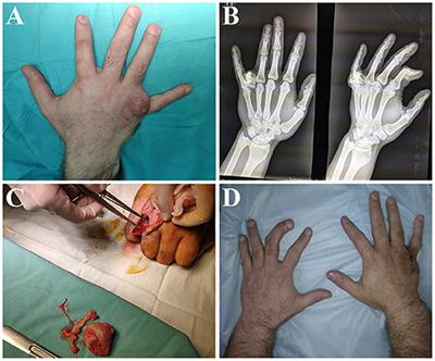 Case Report: Osteomyelitis of the Proximal Phalanx of the Finger in Patient With Ollier Disease